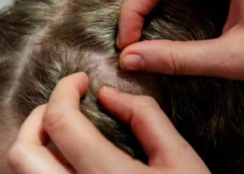 Recomiendan revisar la higiene personal de los alumnos para evitar brote de piojos