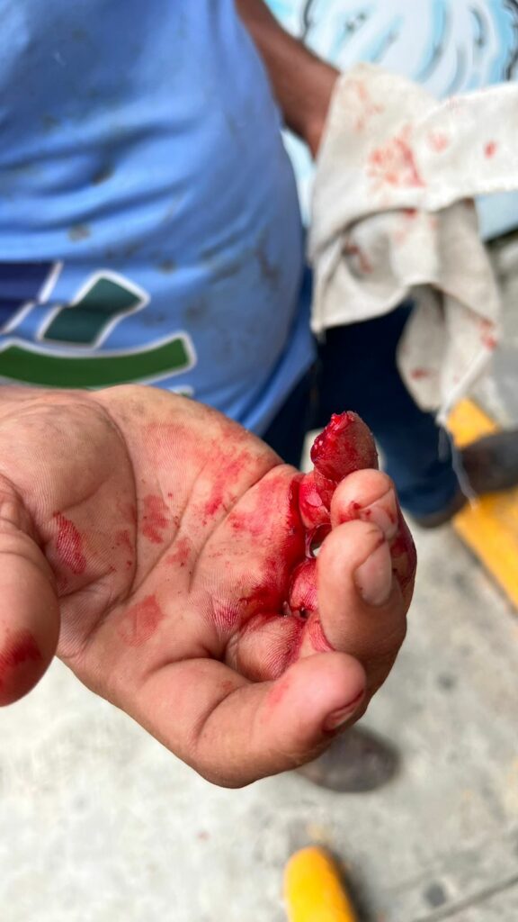 Turista arranca parte del dedo a empleado municipal afuera de un Oxxo en Playa del Carmen